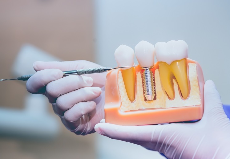 WHY IS DENTAL TREATMENT EXPENSIVE - Dental Excellence