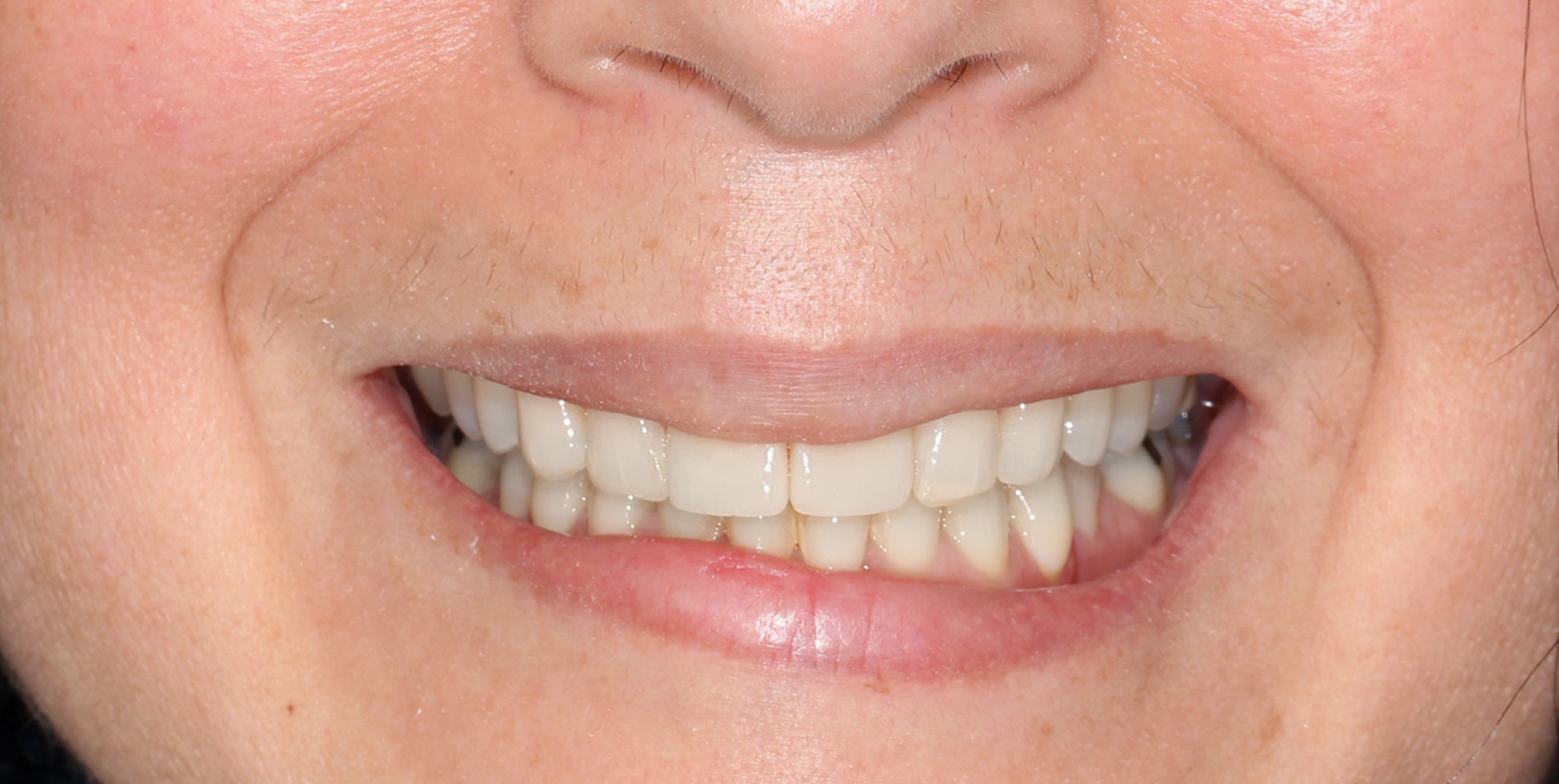 Smile Gallery SimpliSmiles Hicksville, NY & Farmingdale, NY