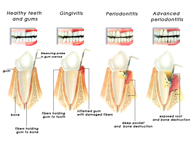 mouth-body-connection-of-periodontal-disease-auburn-dental-center