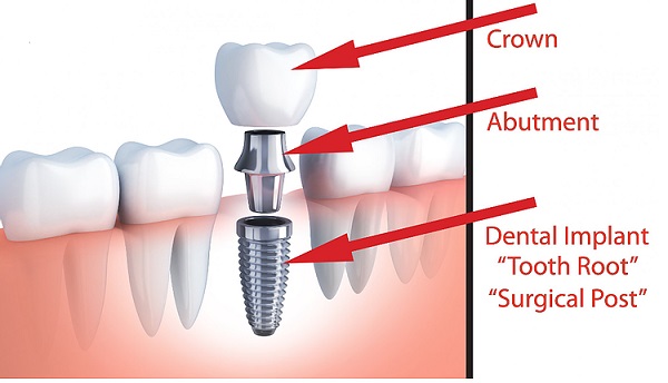 abutment teeth