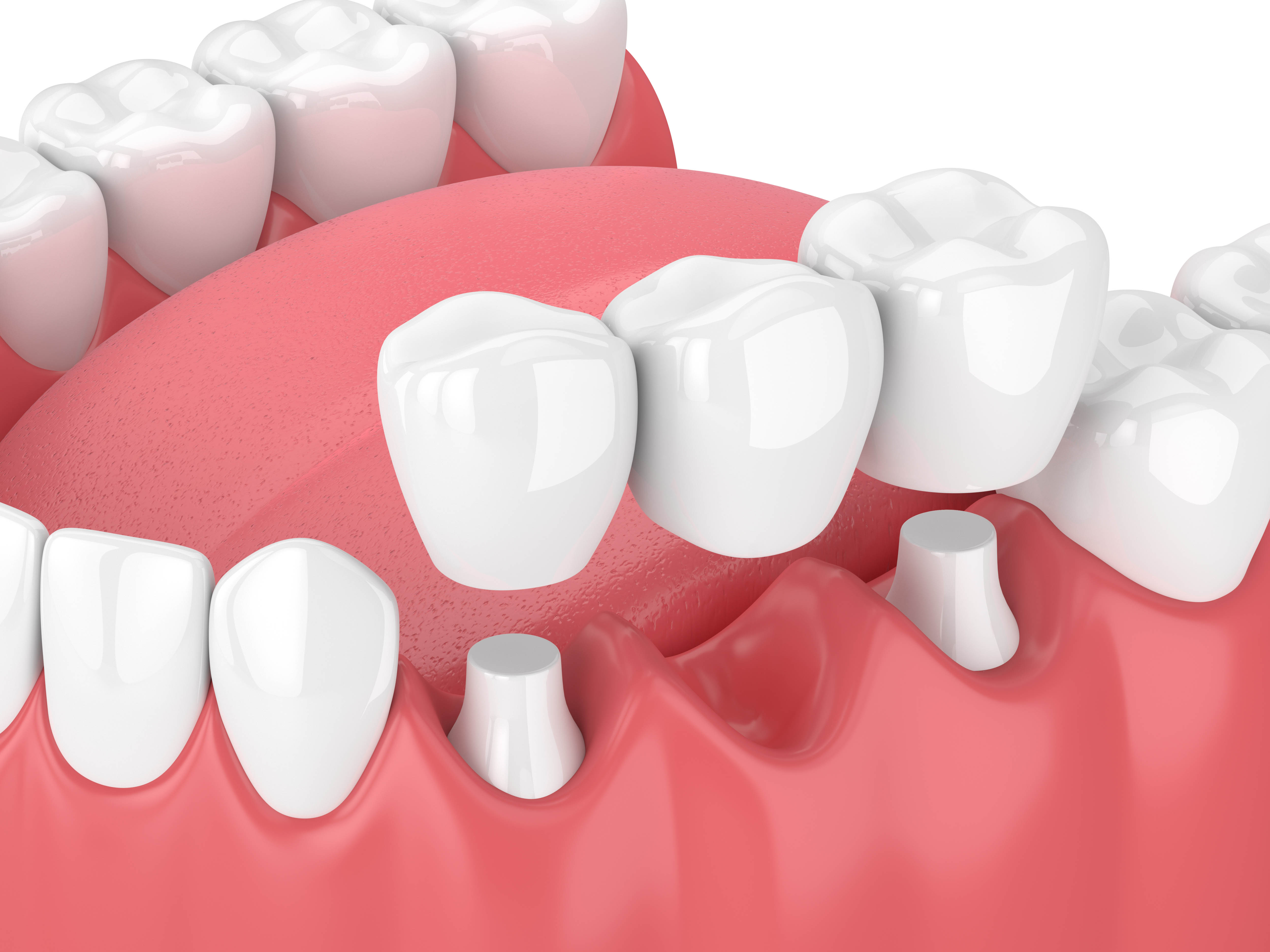 Cosmetic Dentistry in Temecula CA | Choice Dental