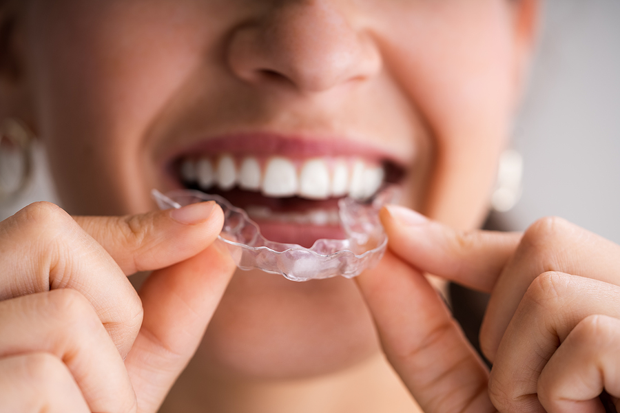 Invisalign - Your Hassle-free Alternative To A Perfect Smile