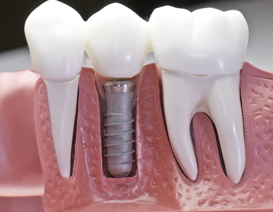 IF YOU HAVE DENTAL IMPLANTS, YOU MAY NEED TO KEEP AN EYE OUT FOR PERI ...