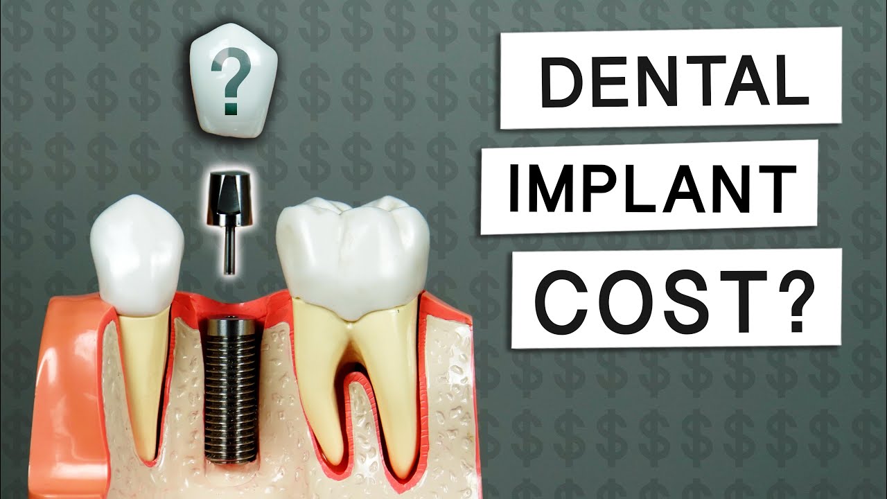 When getting the cheapest dental implant costs you way more! Eldridge