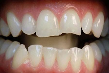 facial filling before image