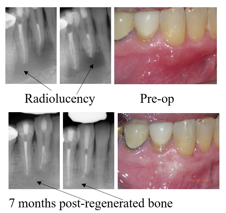 Endodontic Root Canal Surgery Apicoectomy Providence Ri 7665