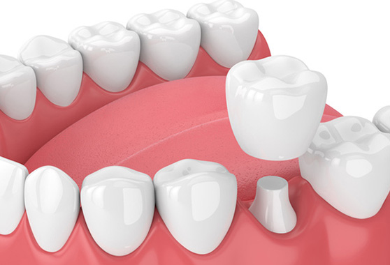 Dental Fillings San Diego  Dentist Smile Designers Point Loma