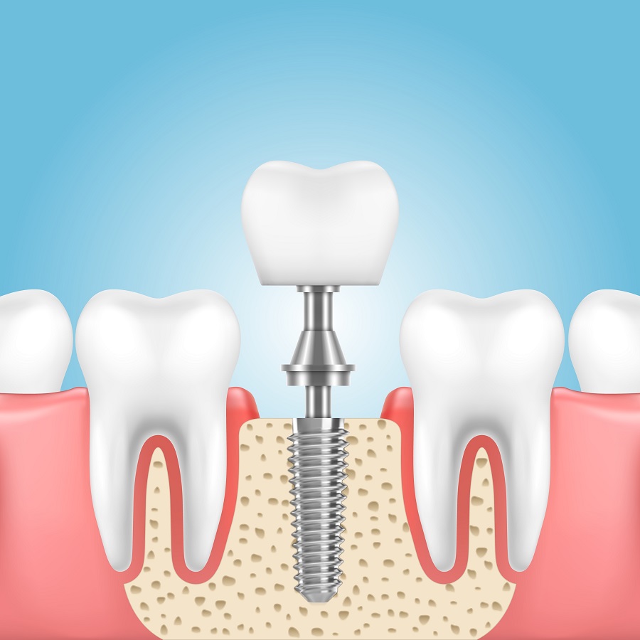 Dental Implants
