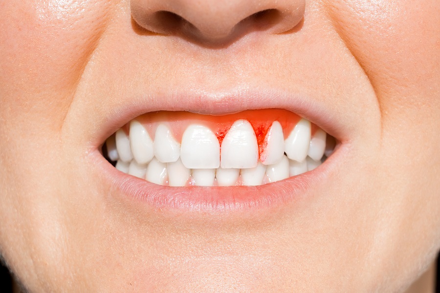 The Link Between Diabetes and Gum Disease Risk