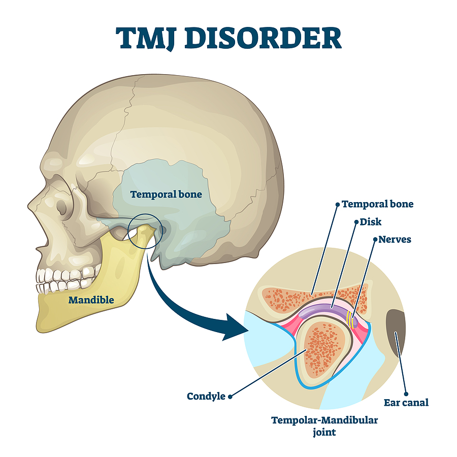 When To See Your Dentist About TMD (Temporomandibular Joint Disorder)