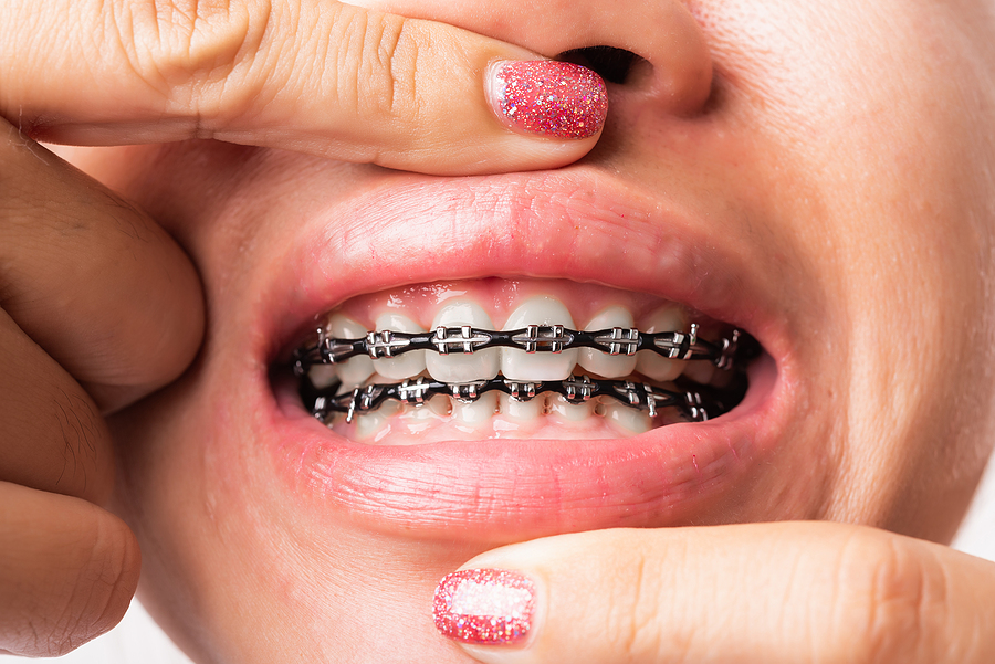 Difference Between Retainers and Dental Braces