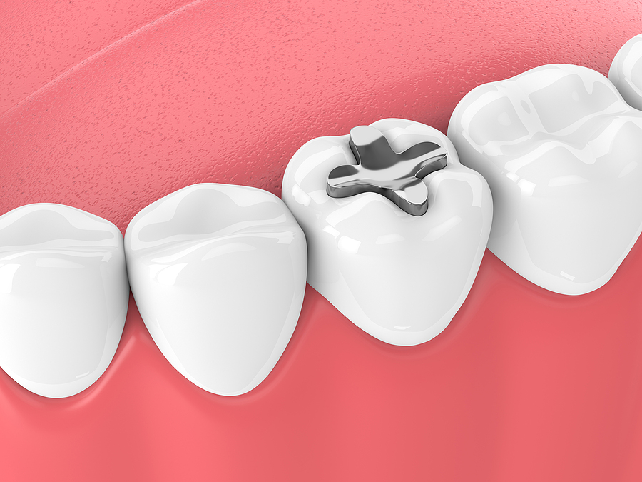 The Importance of Dental Fillings: Restoring and Protecting Your Smile