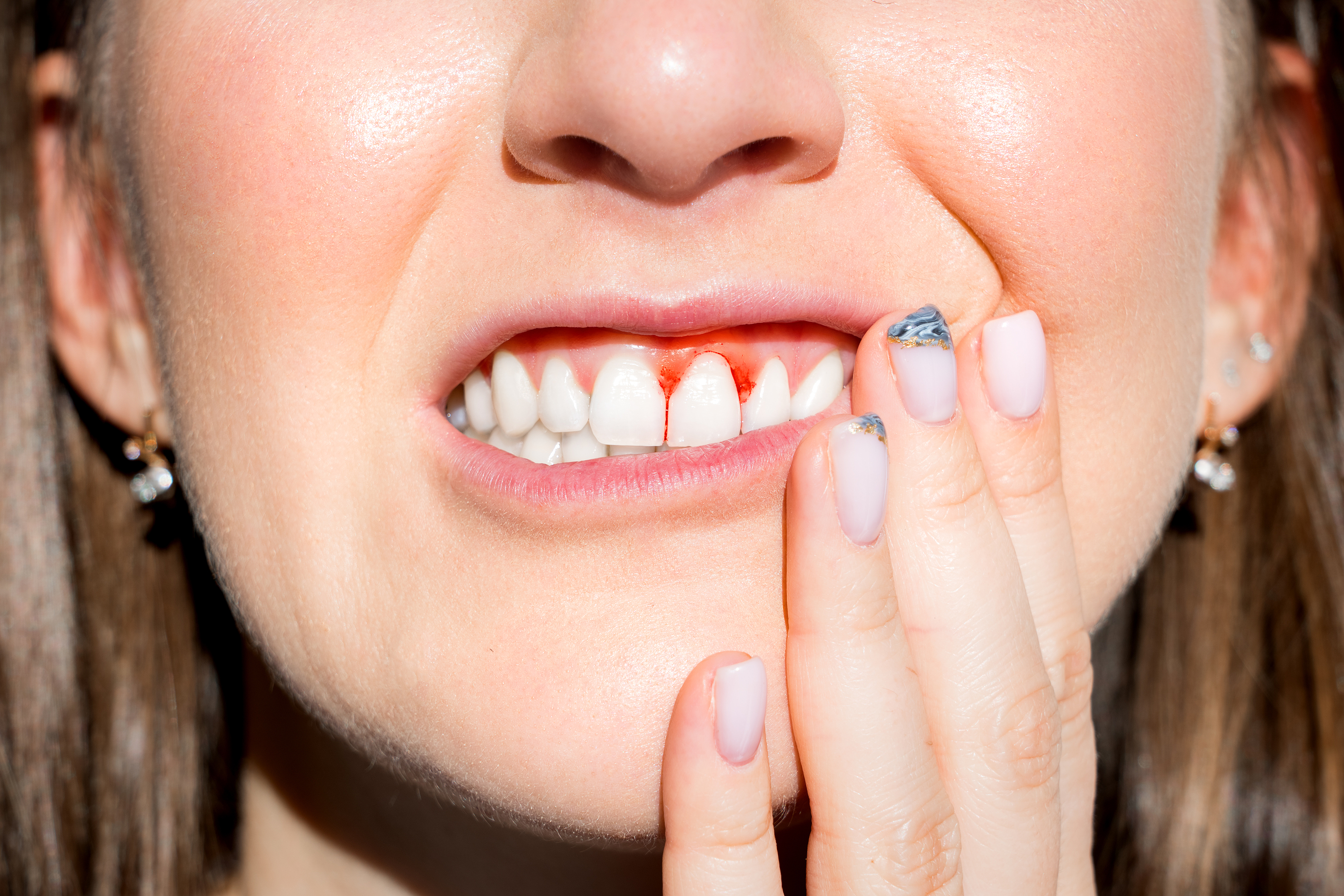 What Is Gum Disease?