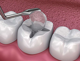 Cavity Repair