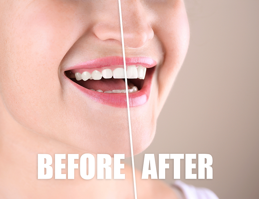 Achieve a Beautiful Smile with Gum Contouring in Pasadena, CA