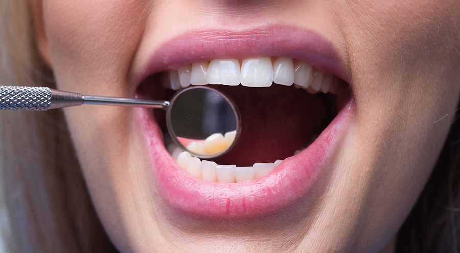 Smile Makeover in Pasadena, CA