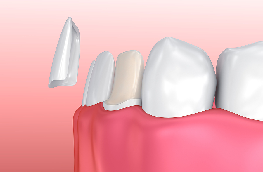 Enhancing Your Smile with Dental Veneers