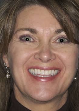 starla-before