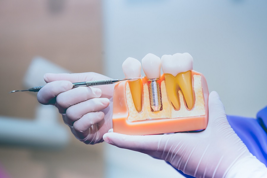 How Can I Tell If My Dental Implant Is Failing? Edgewater Dental