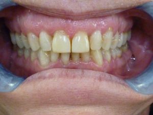 before-after