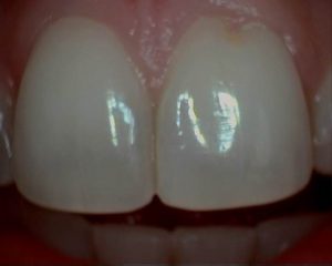 before-after