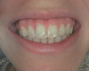 before-after