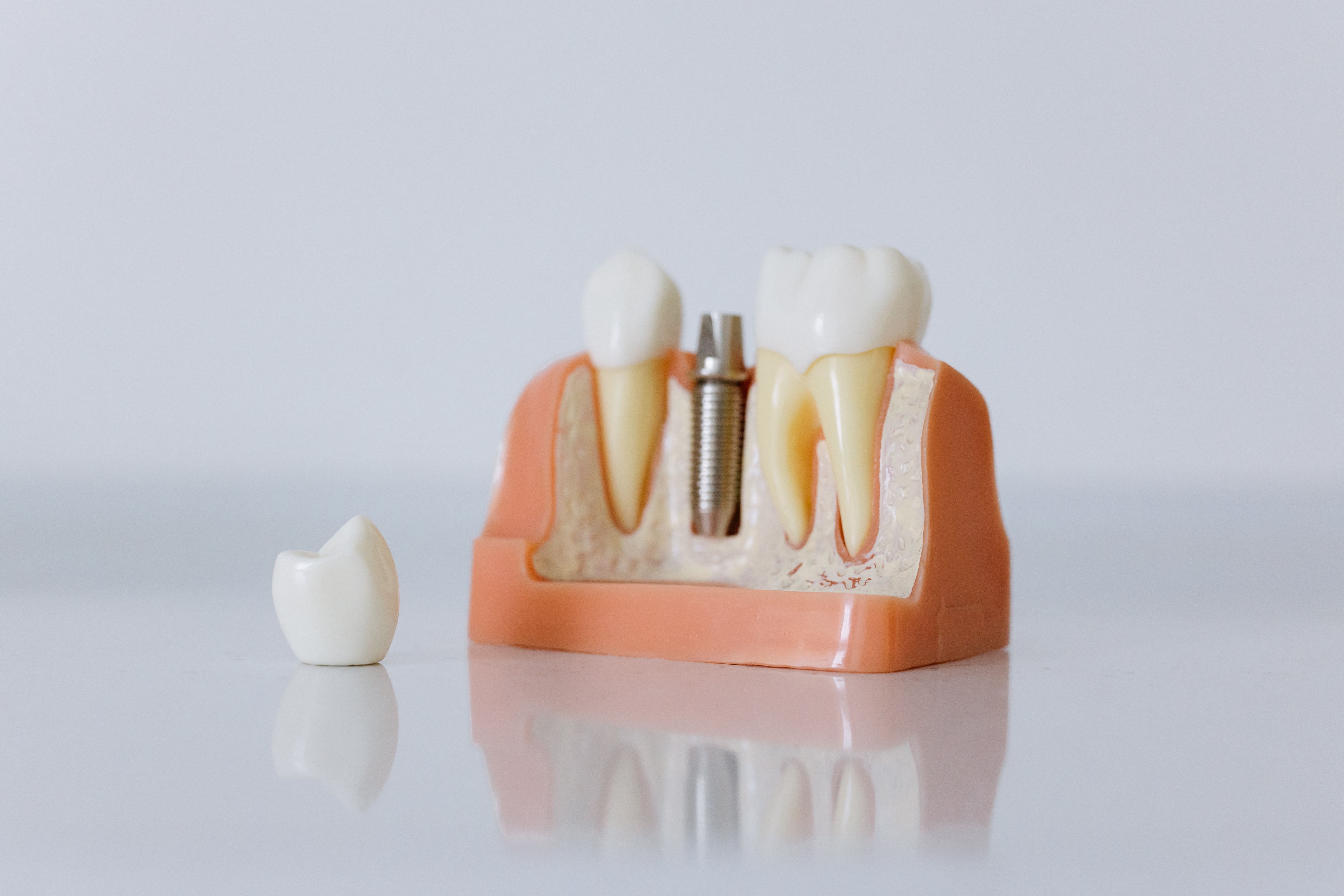 The Long-Term Benefits of Dental Implants: Why They're Worth the Investment