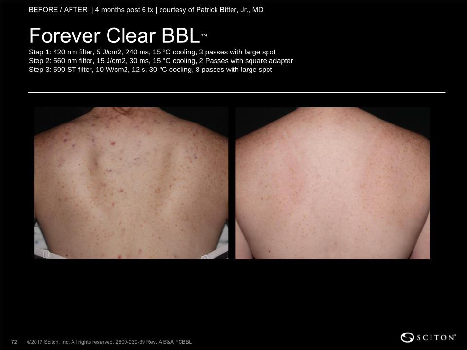 Diminish Acne Scars for Good with BBL : Shantique Med Spa: Med Spa