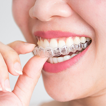 Clear Aligners Clear Aligners