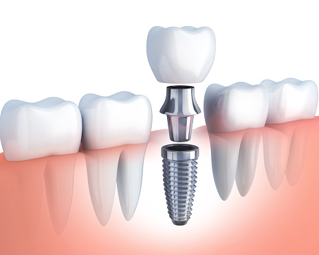 Single Tooth Implants Single Tooth Implants
