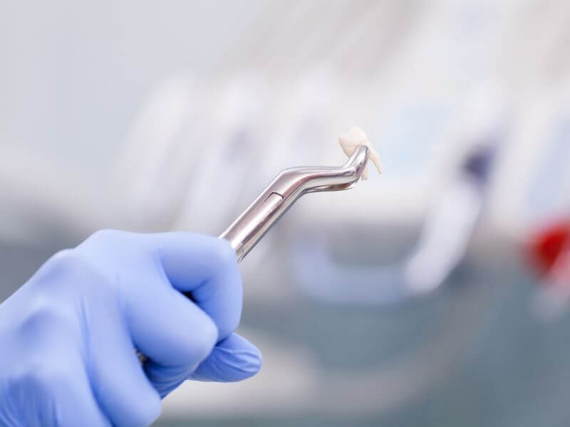 Tooth Extractions Tooth Extractions