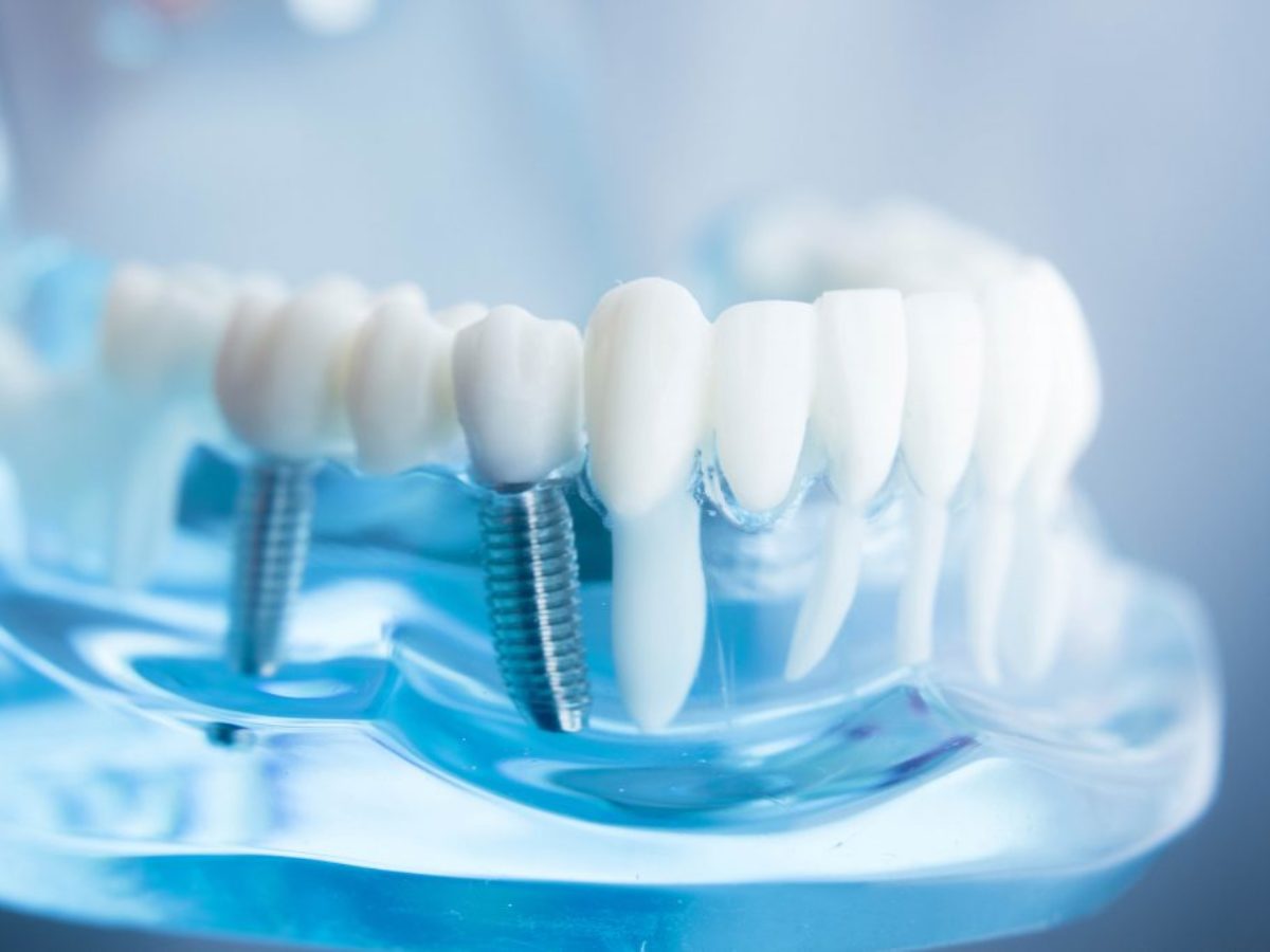 Multiple Tooth Implants Multiple Tooth Implants