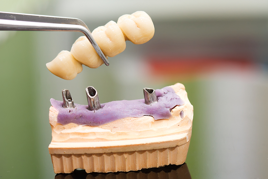 Dental Implants: A Solid Choice