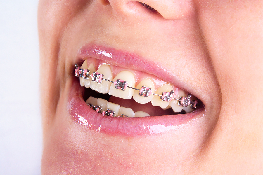 Think Outside the Braces to Straighten Your Smile