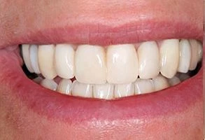 smile-after