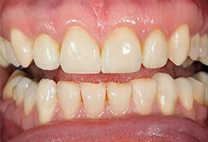 smile-after