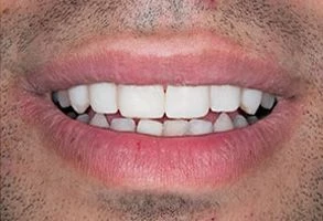 smile-after