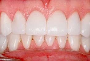 smile-after