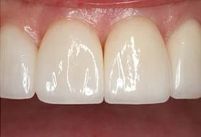 smile-after