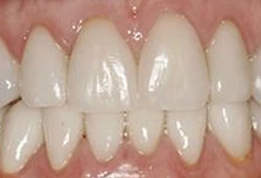 smile-after
