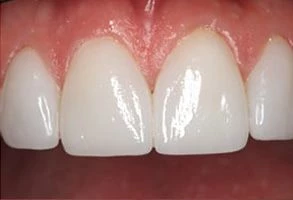 smile-after