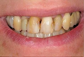 smile-before