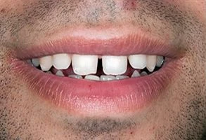 smile-before