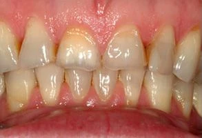 smile-before