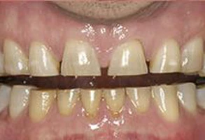 smile-before