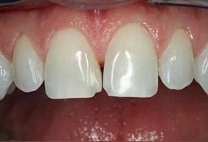 smile-before