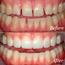 Bonding before & after Bonding before & after