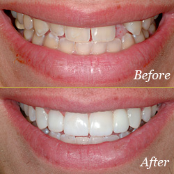 Bridges - Before & After Bridges - Before & After