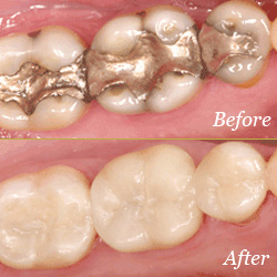Fillings - Before & After Fillings - Before & After