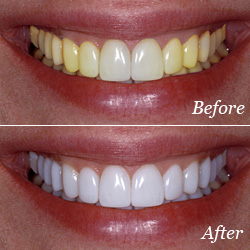 Teeth Whitening - Before & After Teeth Whitening - Before & After